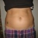 Before smart lipo - front